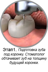 Этап 1. Обточка зубов.