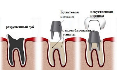 Применение вкладок в протезировании зубов