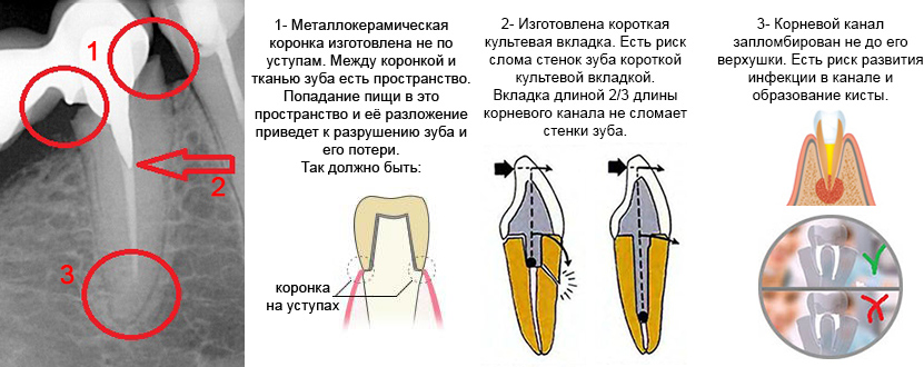 Пример ошибок в протезировании зубов коронками.